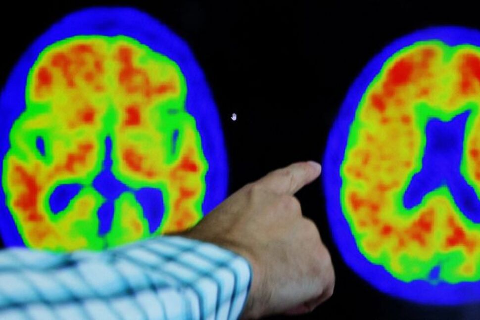 Researchers Return to Alzheimer’s Vaccines, Buoyed by Recent Drug Success